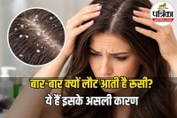 Dandruff Causes Treatment