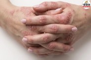 Eczema Cause