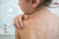 Measles Symptoms, Rubeola Virus, MMR Vaccine,