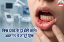 Mouth Ulcer In Summer