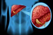 Fatty Liver