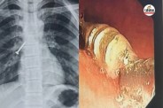 Udaipur airway surgery