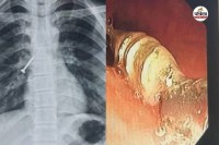 Udaipur airway surgery