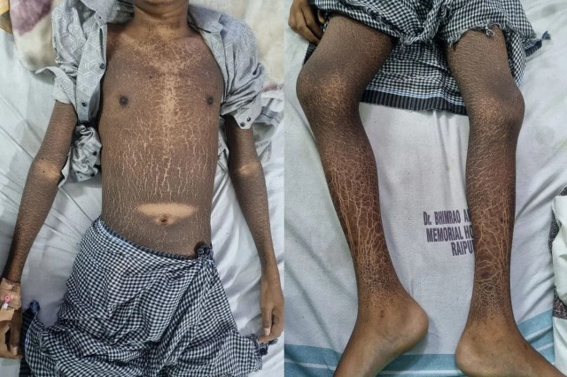 Chhattisgarh news, raipur ambedhkar hospital