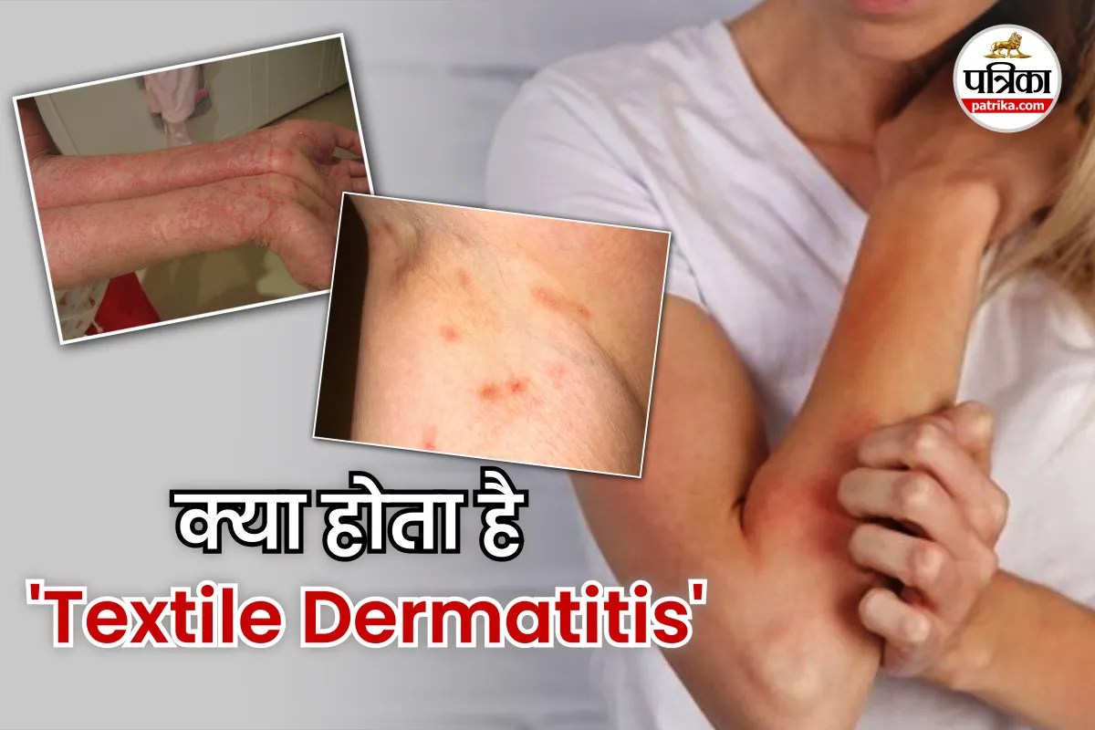 Textile Dermatitis
