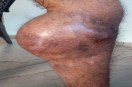 Civil hospital Hemophilia
