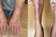 Minocycline induced hyperpigmentation, Rare antibiotic side effects, Skin turning black and blue from medication,