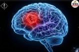 Brain tumor research, Testosterone and brain cancer, Glioblastoma treatment,