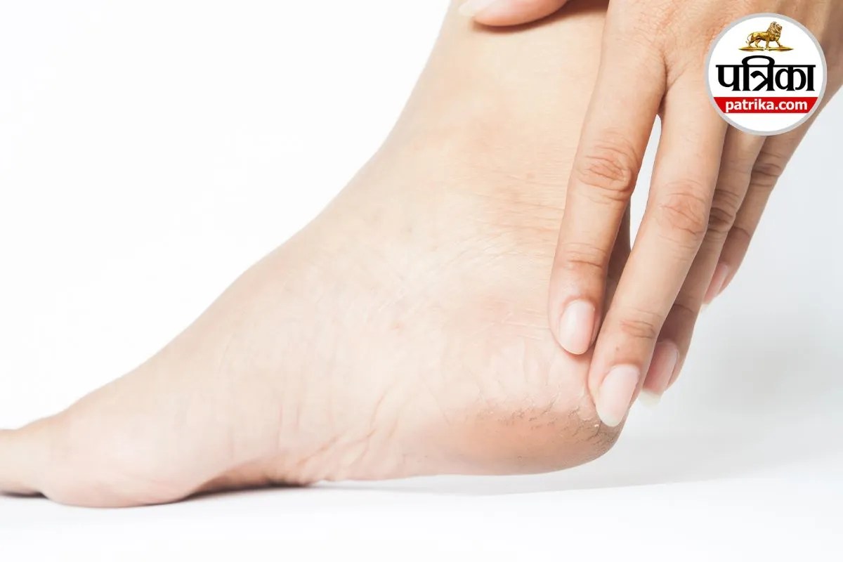 Cracked Heels, Diabetes Signs, Thyroid Symptoms, Vitamin Deficiency,