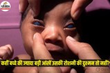 Congenital Glaucoma
