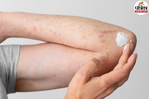 Red rashes on skin in summer, Heat rash treatment summer, Prickly heat remedies,
