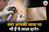 Cherry Angioma Campbell de Morgan spots Blood Vessels Benign Macules Papules