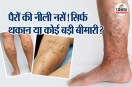 Varicose Vein Pregnancy hormone Blood circulation Calf Muscles Peripheral Heart