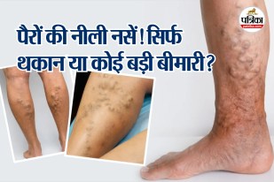 Varicose Vein Pregnancy hormone Blood circulation Calf Muscles Peripheral Heart