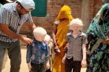Albinism