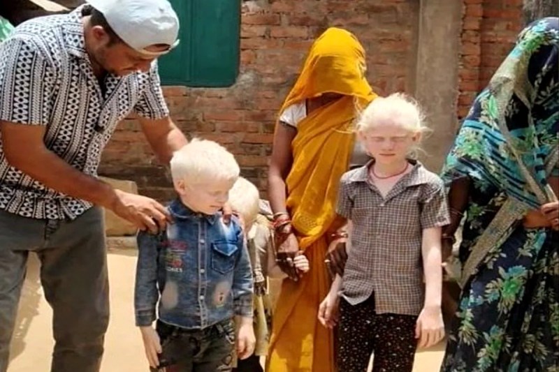 Albinism