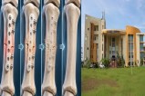 Bhilai News: अब शरीर में खुद घुल जाएंगे हड्डियों के प्लेट-स्क्रू, दूसरी सर्जरी की जरूरत होगी खत्म,