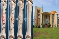 Bhilai News: अब शरीर में खुद घुल जाएंगे हड्डियों के प्लेट-स्क्रू, दूसरी सर्जरी की जरूरत होगी खत्म,