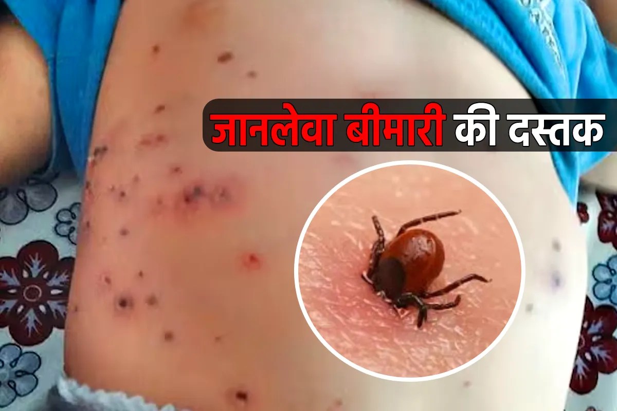 Scrub Typhus