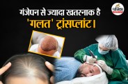 Hair Transplant in India