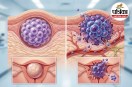 Malignant Tumor Cancer Symptoms Tumor Diagnosis NIH Cancer Research