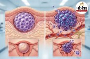 Malignant Tumor Cancer Symptoms Tumor Diagnosis NIH Cancer Research
