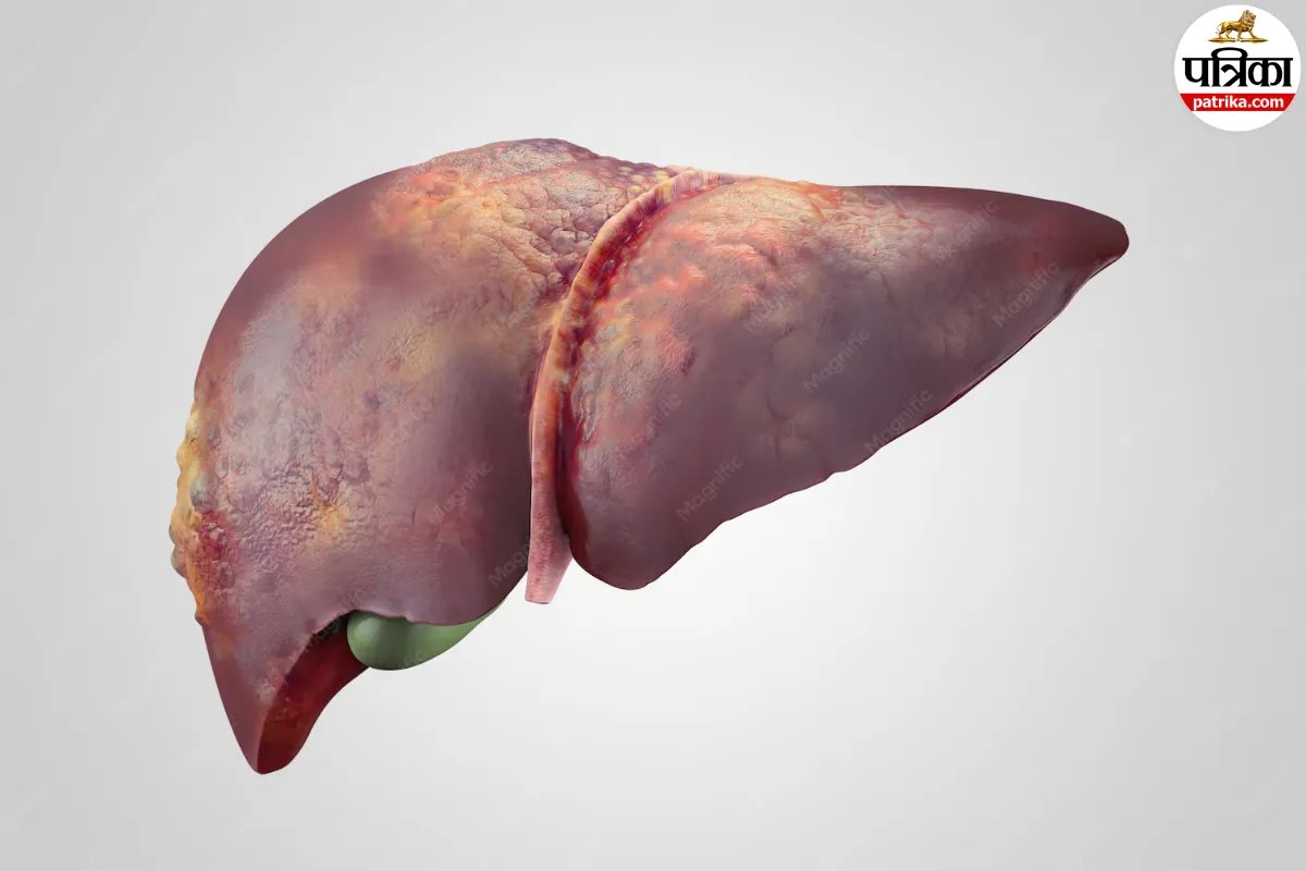 Fatty liver disease signs, Bilirubin levels eye yellowing, Liver health and blurry vision,