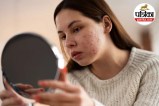 Hormonal Acne, Periods, PCOS, Women's Health,