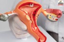 Ovarian cancer new treatment NHS, Mirvetuximab soravtansine ovarian cancer, Targeted therapy for ovarian cancer,