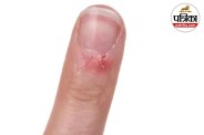 Paronychia Nail Infection Nail Infection Symptoms Paronychia Symptoms in Hindi