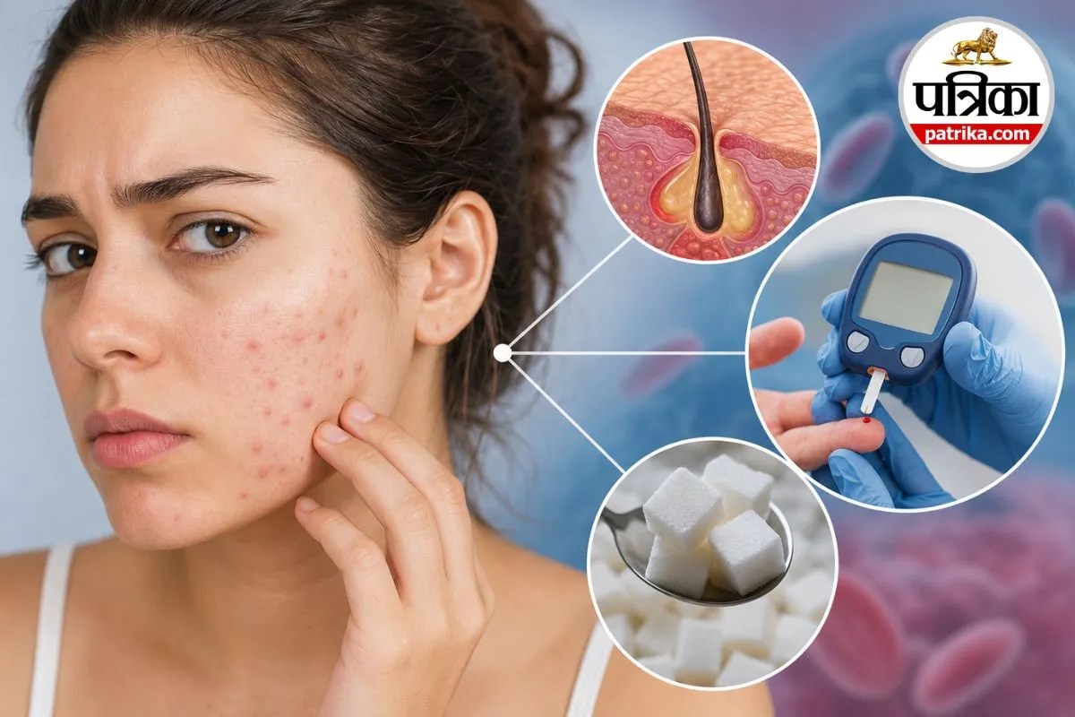 Pimples, Acne, Blood Sugar, Diabetes,