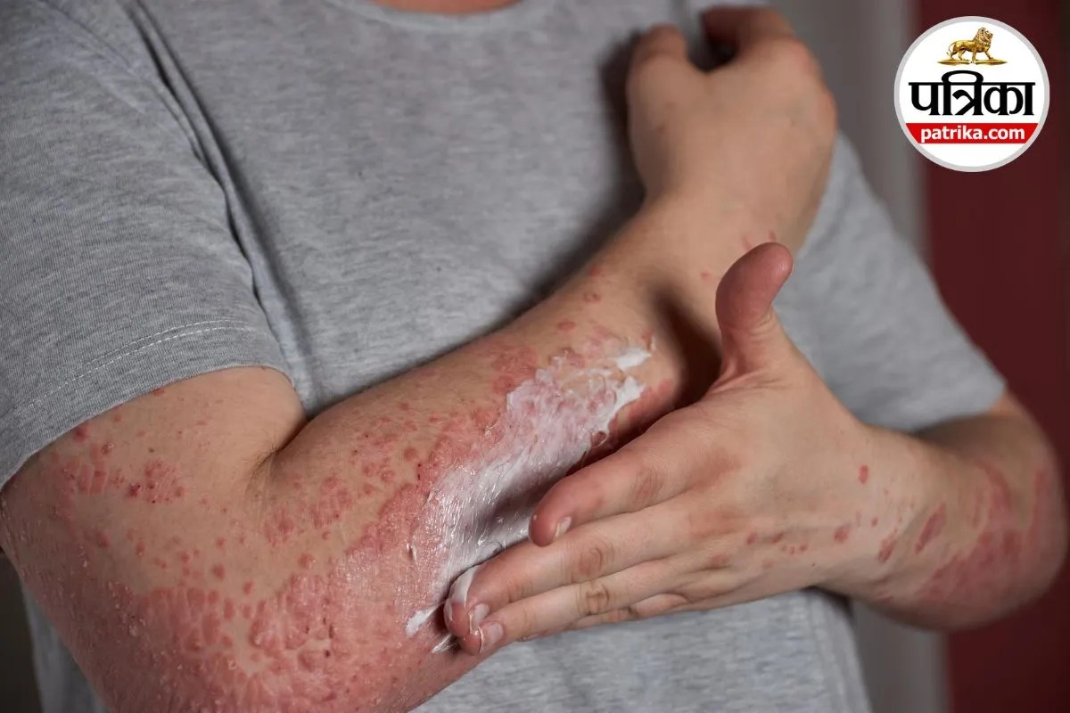 Viral Rash in Children HHV-6 Infection बच्चों में तेज बुखार Roseola Treatment