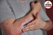 Viral Rash in Children HHV-6 Infection बच्चों में तेज बुखार Roseola Treatment