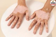world vitiligo day 2026,vitiligo causes and symptoms,is vitiligo contagious,