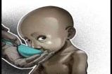 Children born with diseases from the womb, malnutrition, tuberculosis, and hole in the heart
