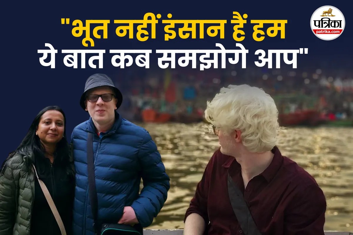 Albinism Awareness Day 2026 Special Story, Albinism In India, Albinism People Story In Hindi,