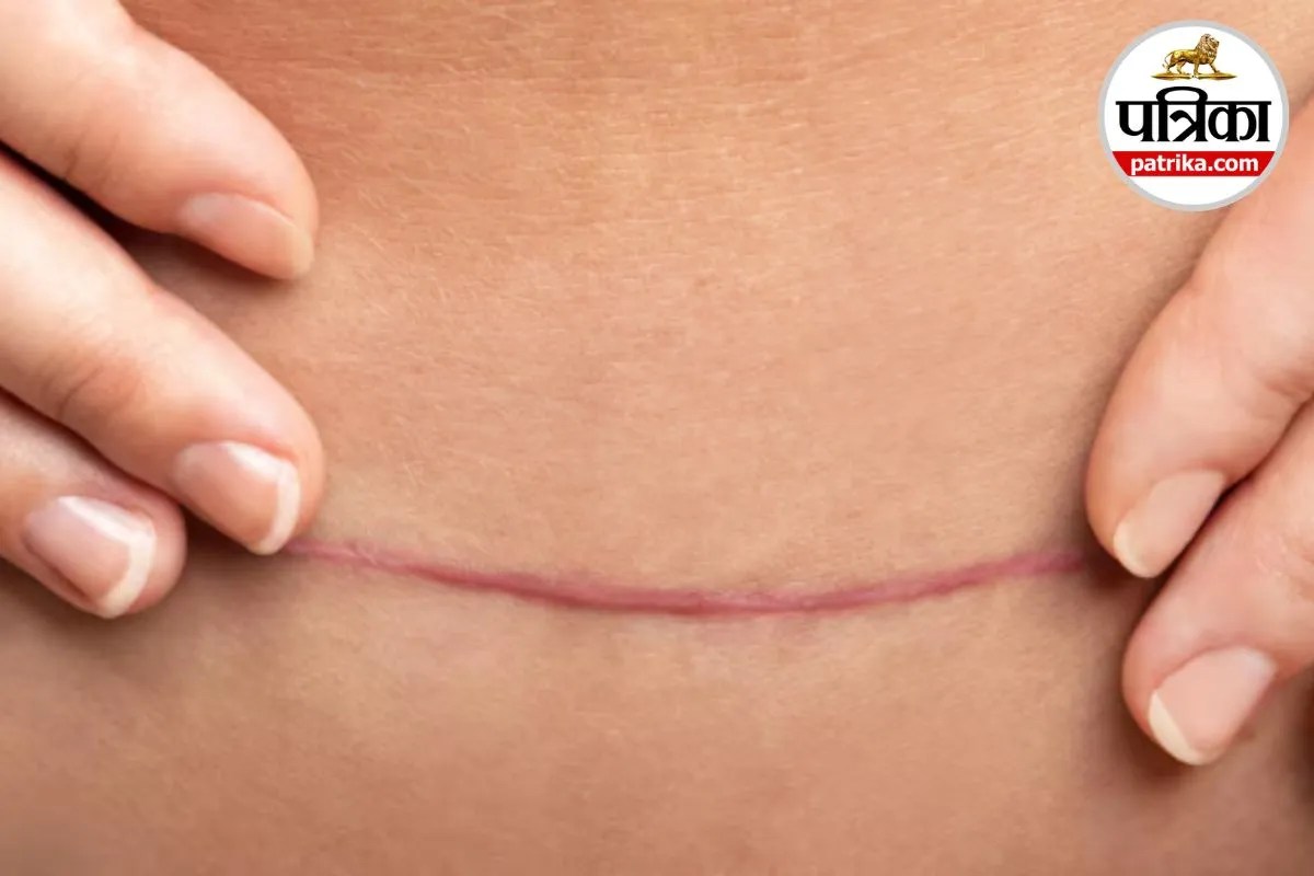 C-Section Healing Signs, C-Section Recovery, C-Section Stitches,