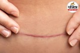 C-Section Healing Signs, C-Section Recovery, C-Section Stitches,