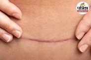 C-Section Healing Signs, C-Section Recovery, C-Section Stitches,