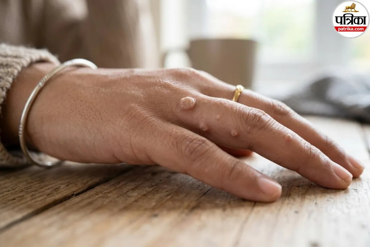 Common warts symptoms,Causes of warts on hands,Human papillomavirus skin signs,