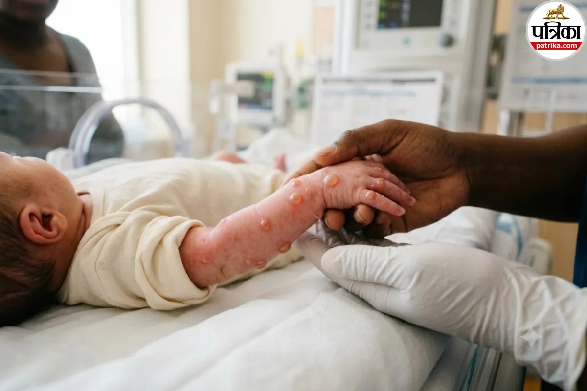 Epidermolysis bullosa symptoms,Butterfly skin disease in babies,Causes of epidermolysis bullosa,