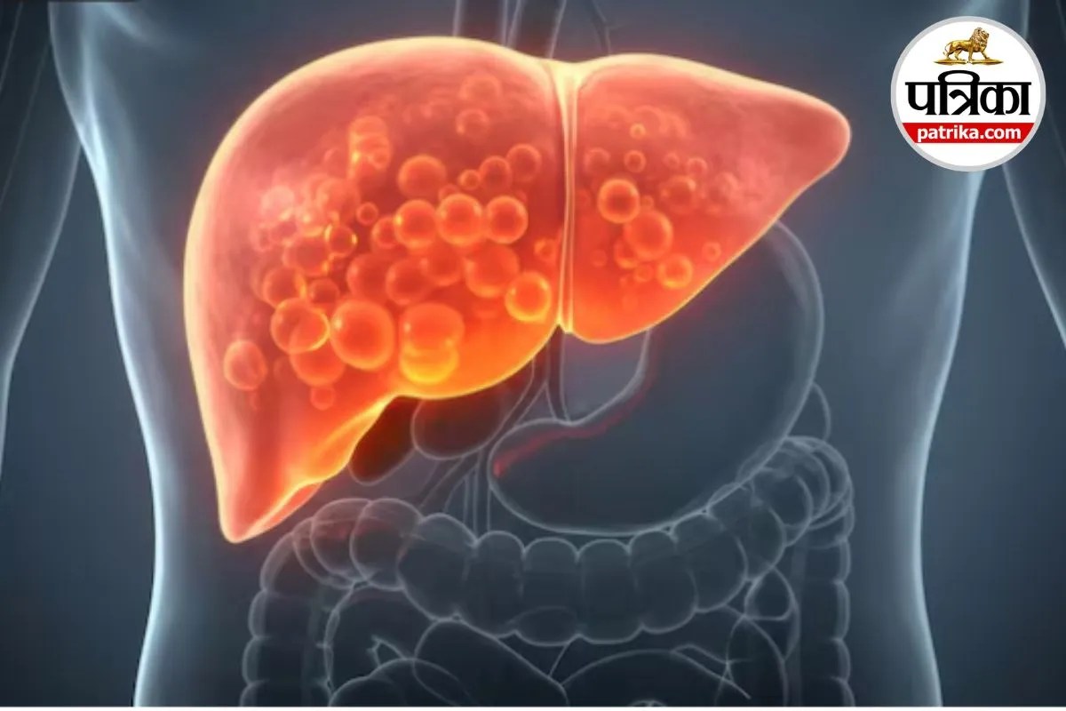 Fatty Liver Treatment Fatty Liver Fatty Liver in Hindi