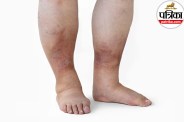 early signs of gangrene,what causes gangrene in toes,gangrene symptoms and treatment,