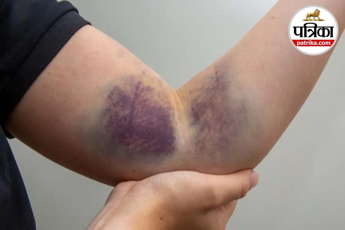 Hemophilia Symptoms Hemophilia Bleeding Disorder