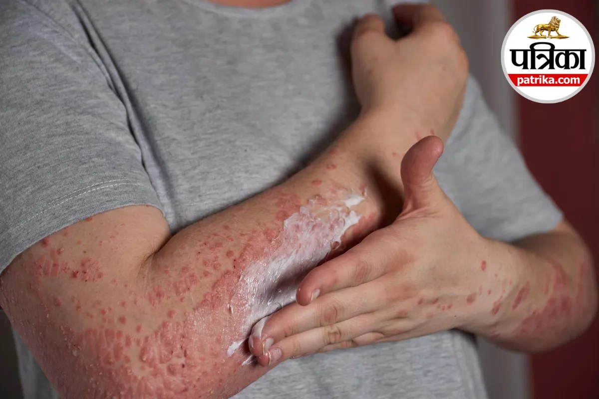 Herpes Zoster,Shingles Symptoms,VaricellaZoster Virus,