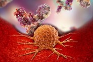 IgG4 Disease Symptoms Tumor Causes in Human Body