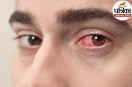 Kawasaki disease symptoms in kids,Kawasaki disease signs in toddlers,High fever red eyes rash in child,