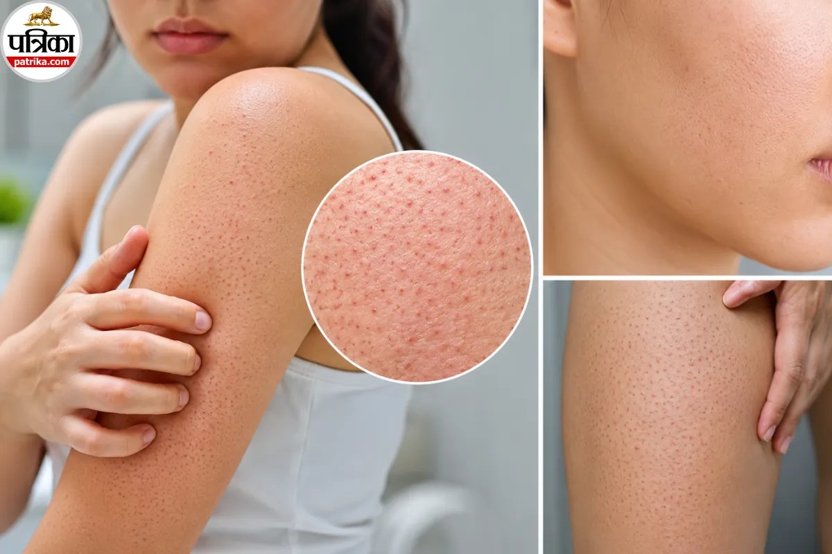 Chicken Skin On Arms, Keratosis Pilaris Treatment