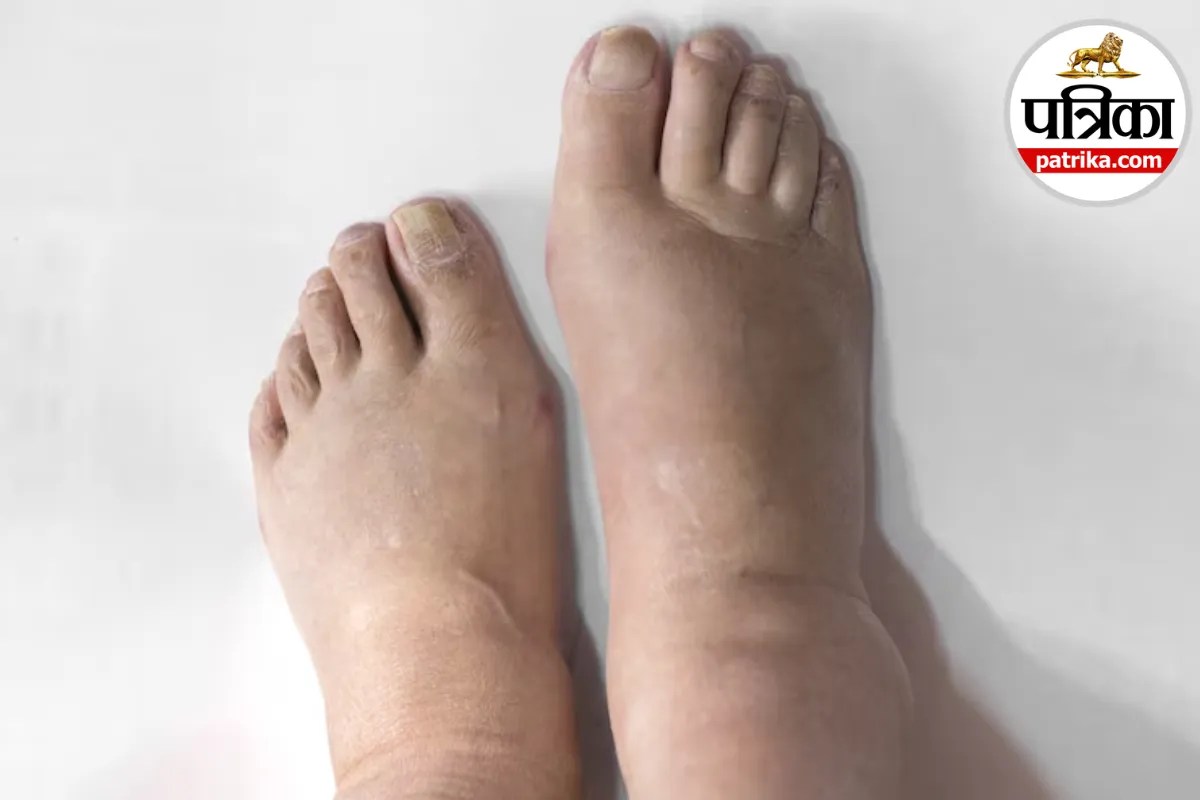 Leg swelling after flying,Mayo Clinic foot swelling,Edema during air travel,