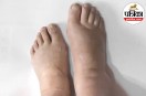 Leg swelling after flying,Mayo Clinic foot swelling,Edema during air travel,